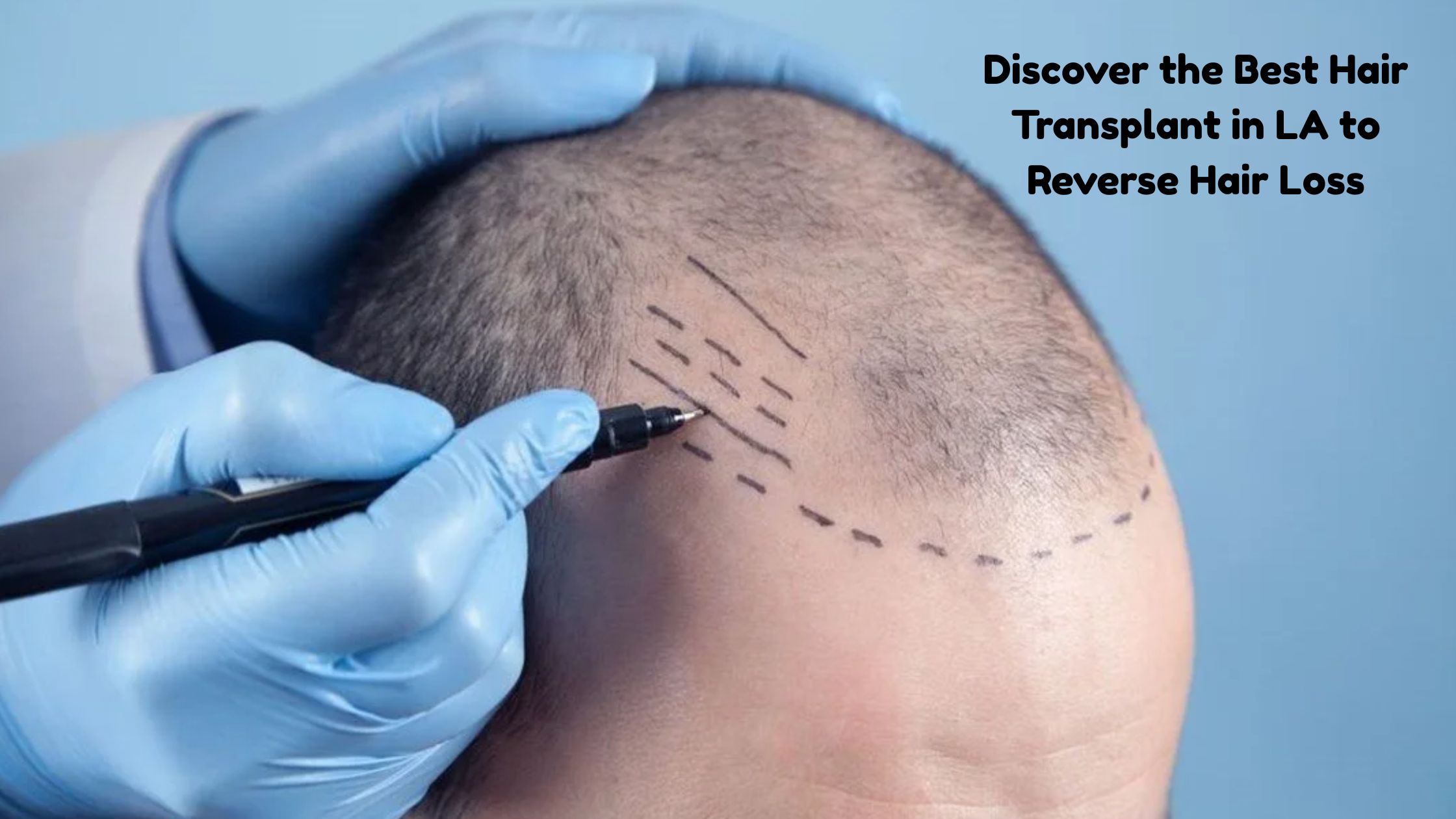 best hair transplant in la