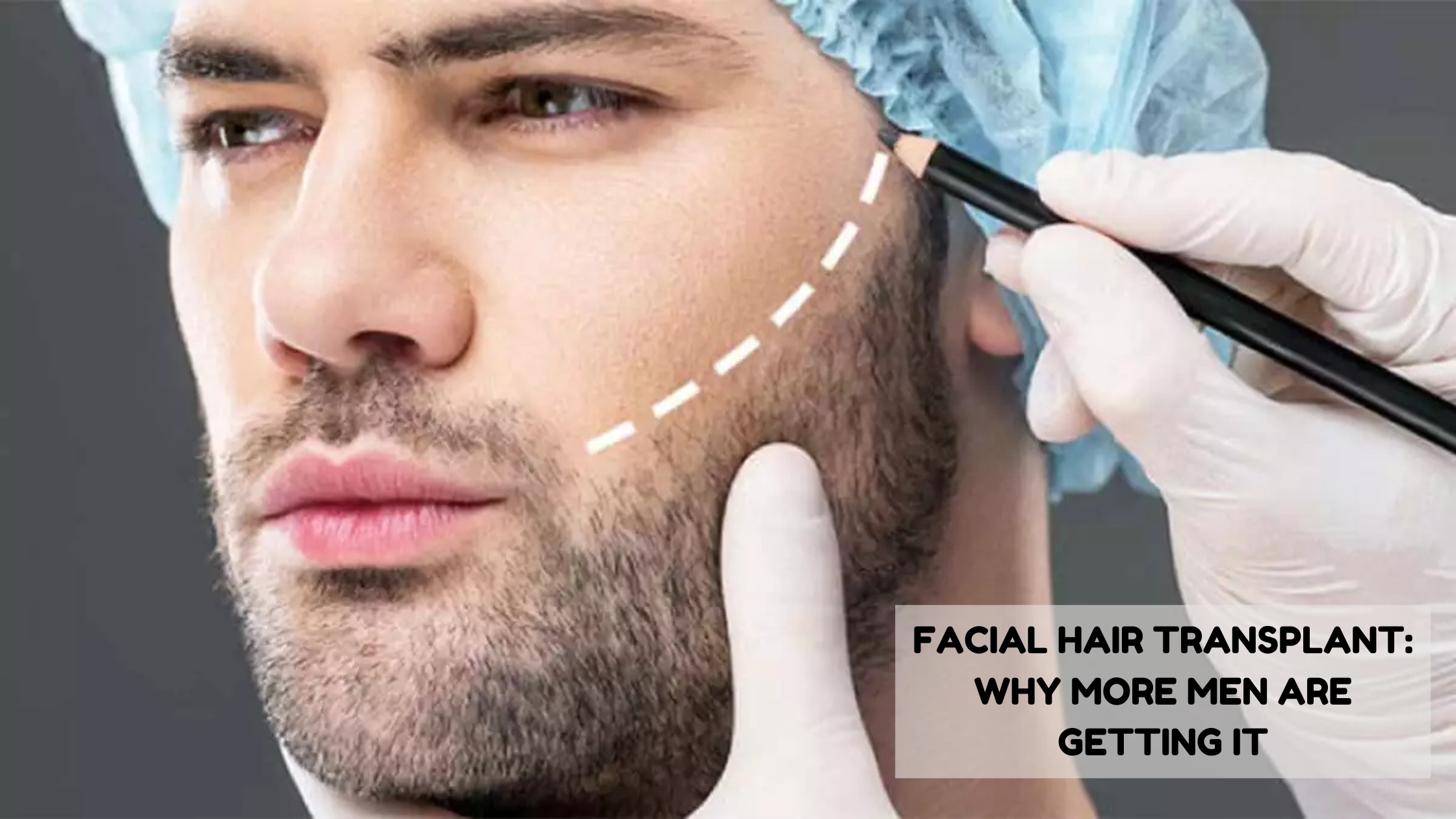 facial hair transplant